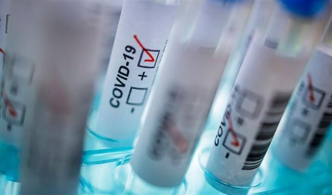 Лабораторно підтверджено 77 нових випадків COVID-19 в області Лабораторно підтверджено 77 нових випадків COVID-19 в області